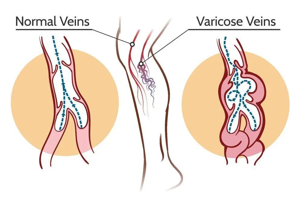 静脉曲张到底是怎么来的，有什么危害?
